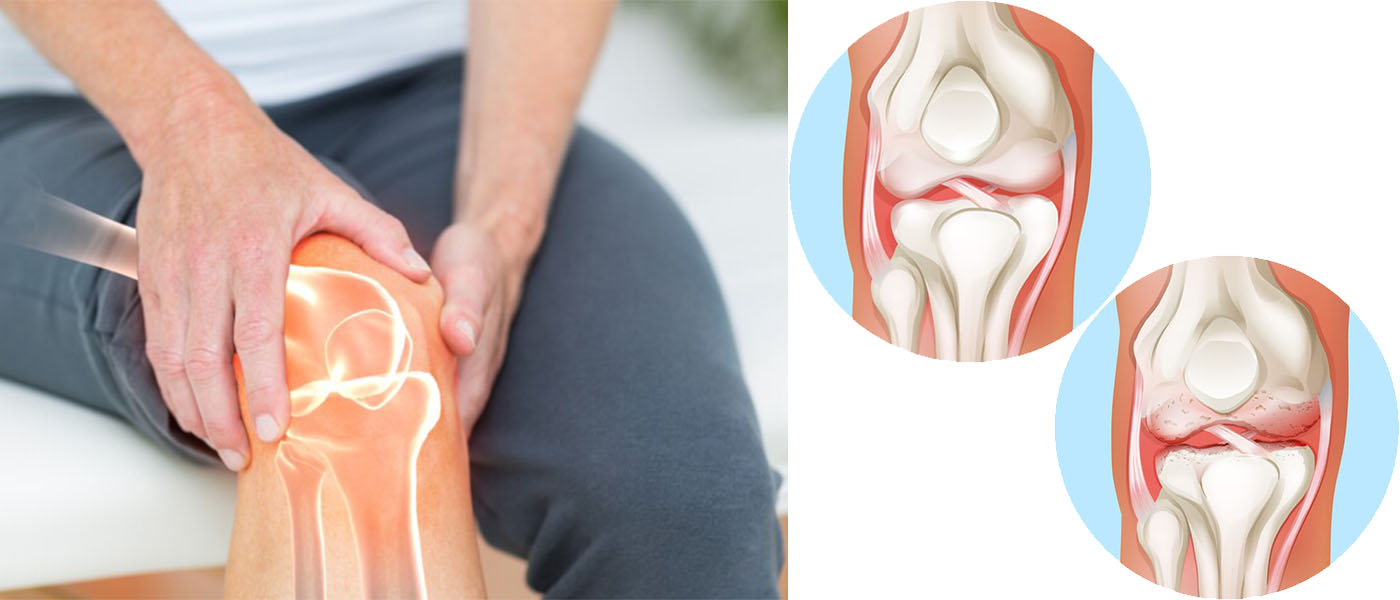 L’arthrose du genou
